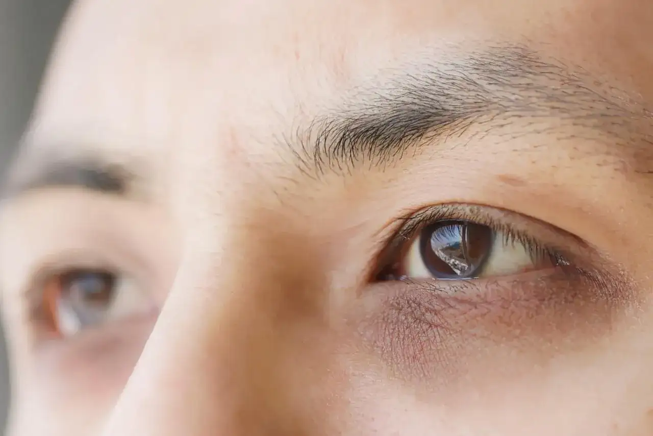 Gros plan sur un œil humain, montrant des cernes prononcés et des ridules, signes évidents de fatigue oculaire après une longue journée.